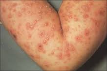 Illustration for article titled obat herpes di tangan